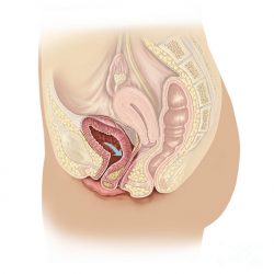 A prosztata helyi fibrózisa Mycoplassain prostatitis