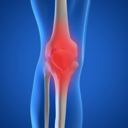 hidrogenizált kollagén a kezelés második fokozatának osteoarthritis