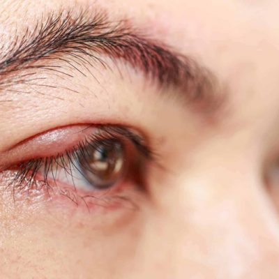 A szemhéjszél gyulladás, blepharitis