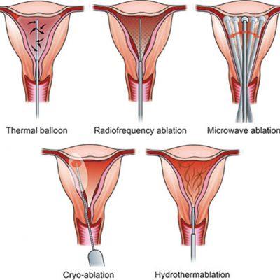 Méheltávolítás helyett endometrium abláció