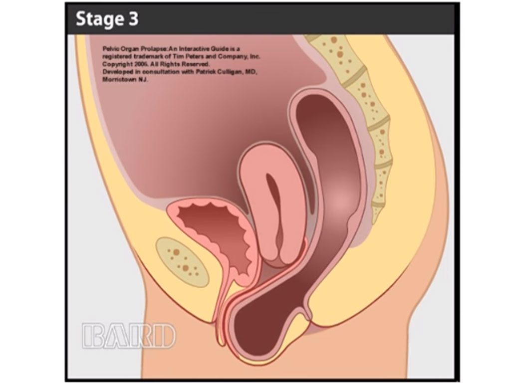 adenocarcinoma prostate a prostatitis jelei az életkorban